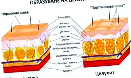 cellulit hogyan cellulit