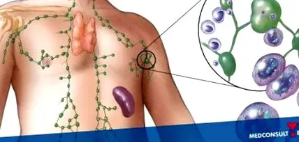 intenzív kezelés lymphoma