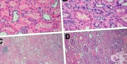 magas vérnyomás nephrosclerosis