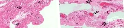 processus vaginalis