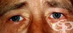 szemhéj Xanthelasma xanthelasma