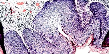 HPV-vel összefüggő