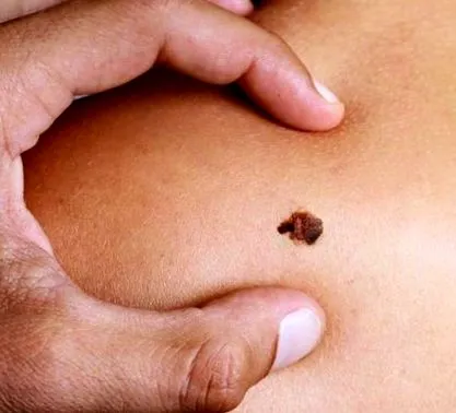 melanoma melanoma kialakulásának