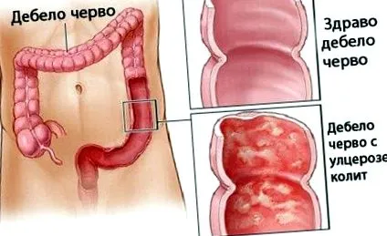 vastagbélgyulladás
