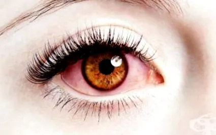 keratitis kezelése