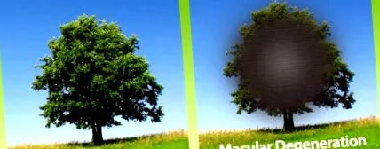 makula degeneráció száraz degeneráció