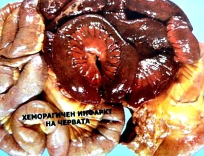mesenterialis trombózis
