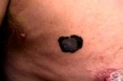 melanoma
