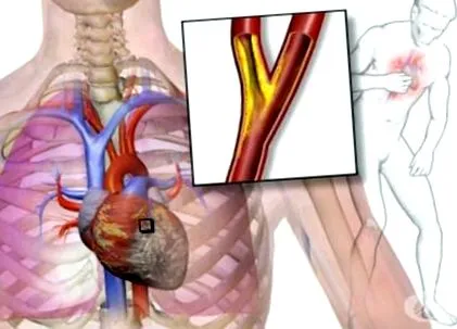 instabil angina instabil anginában