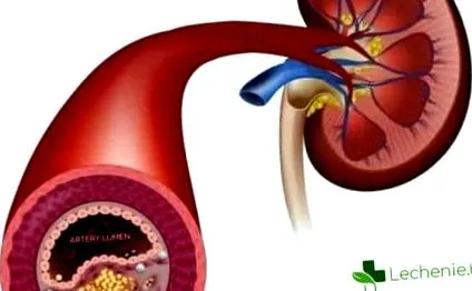 nephrosclerosis hogyan