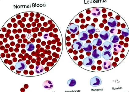 bridgehealth mieloid leukémia