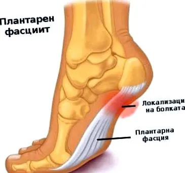fasciitis fasciitis