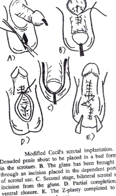 oleogranuloma genitálusok
