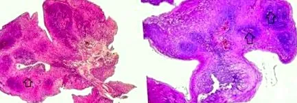 papilloma papilloma
