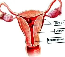 endometrium polipok