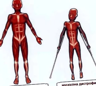 progresszív izomdisztrófia formája progresszív