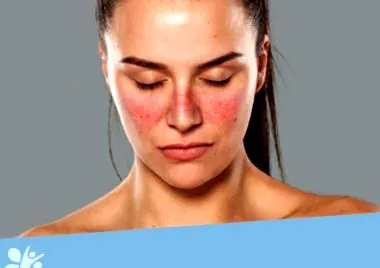 lupus szisztémás