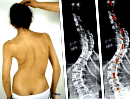 scoliosis kialakulásának vizsgálat során
