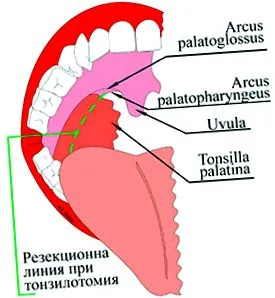 palatális közötti tonsillotomia