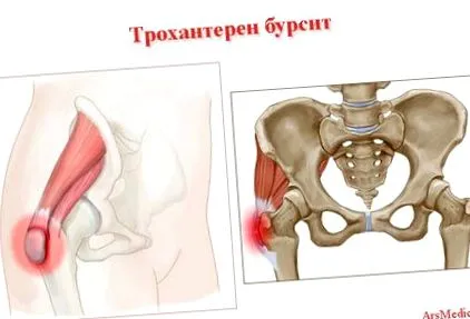 trochanterikus bursitis trochanterikus