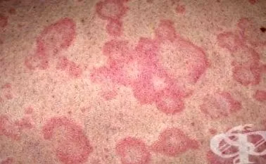 urticaria esetek -ában
