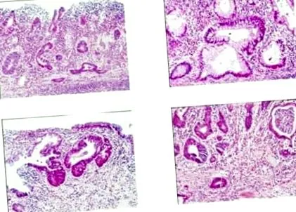 colitis ulcerosa colitis ulcerosa