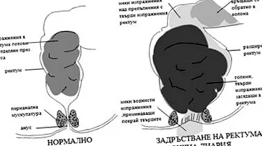székrekedés funkcionális székrekedés