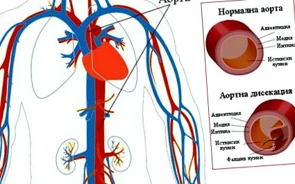 disszekció aorta disszekciójának