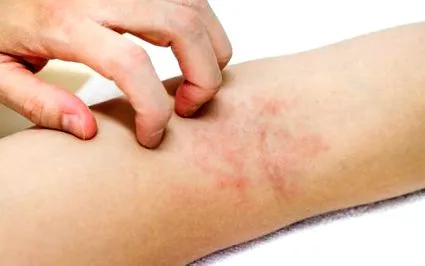 lézeres eltávolítása dermatitis