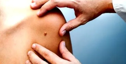 amely általában nevus amely