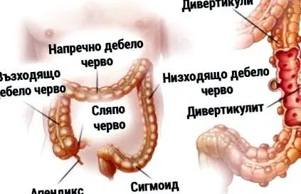 divertikulózis divertikulitisz