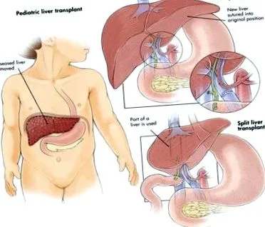 ezért ascites