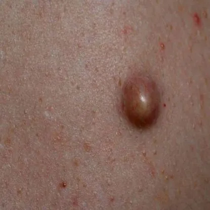 epidermális ciszták