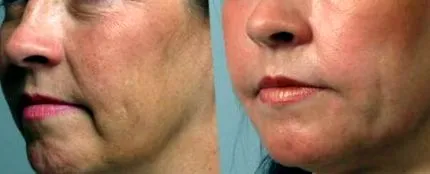 facetite