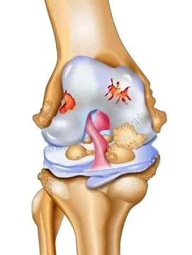 gonarthrosis gonarthrosis