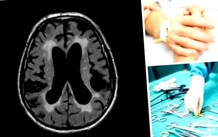 hydrocephalus cerebrospinalis folyadék
