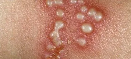 simplex herpes