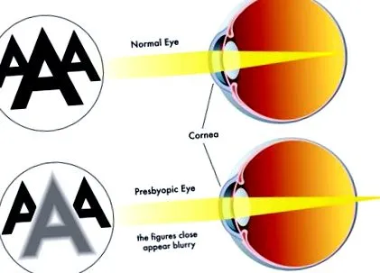 essilor presbiopia