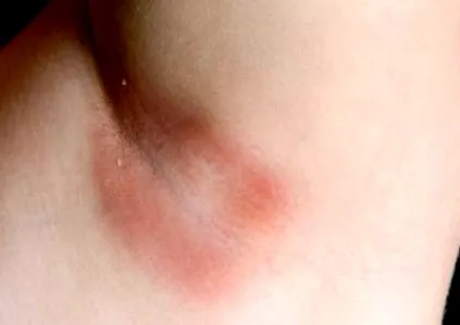 gennyes gennyes hydradenitis