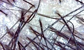fejbőrön seborrheás dermatitis