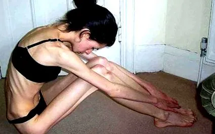 anorexiában szenvedők neurotikus
