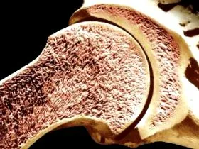 osteoporosis