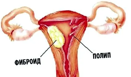 polipjai eltávolítást