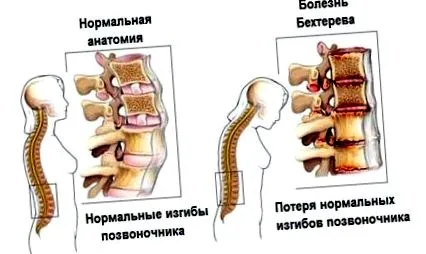 táplálkozás spondylitis