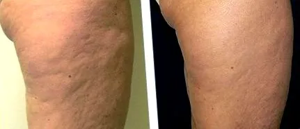 lézertechnikával care