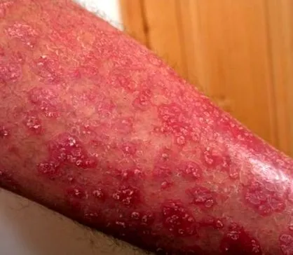 dermatológiai dermatológiai