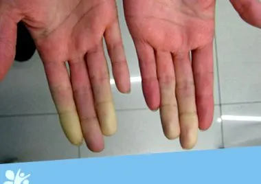erythematosus