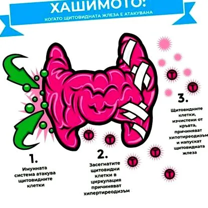 pajzsmirigygyulladása