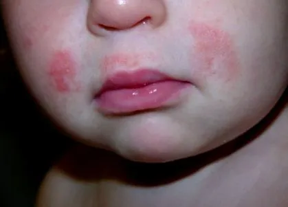 dermatitist dermatitist