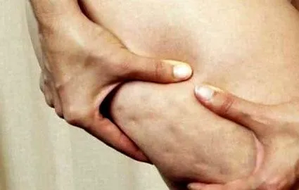 cellulit élelmiszer